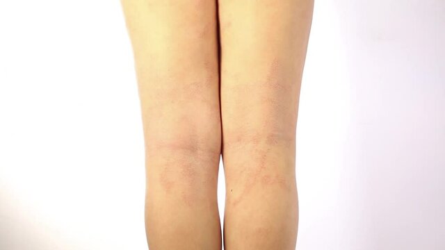 Acute atopic dermatitis on the legs behind the knees of a child is a dermatological disease of the skin. Large, red, inflamed, scaly rash on the legs. Legs of a teenager with severe atopic eczema.