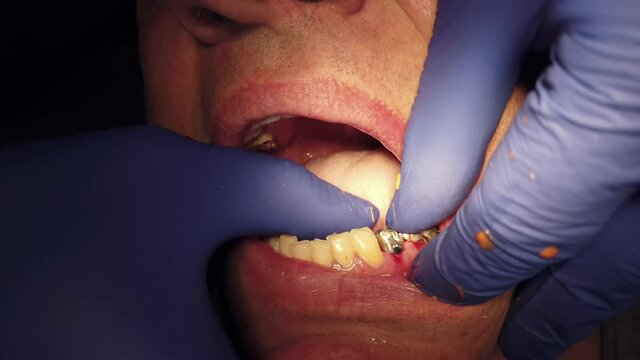 dental implant in the hands of a dentist. An implantation surgery is underway. Titanium implant
