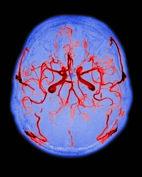 Normal arterial blood supply to the brain