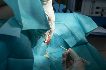  surgeon opens a large abscess with a scalpel in a hospital