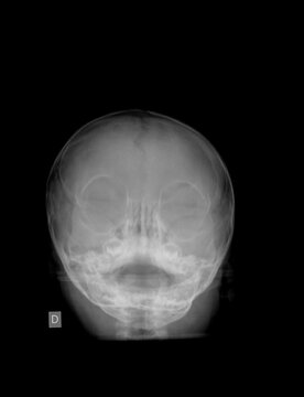 Head x-ray image of the baby film.The scan show normal child skull.