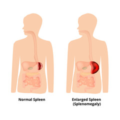 Splenomegaly of the spleen. Enlargement of the spleen. Vector illustration on isolated background - obrazy, fototapety, plakaty