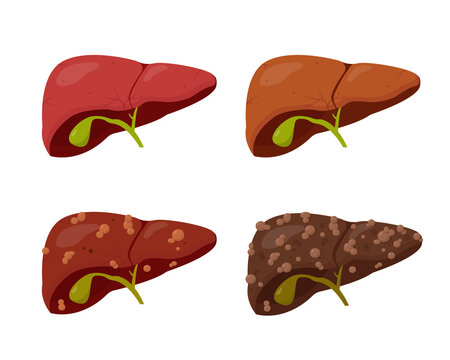 Human liver set. Stages of liver Disease.