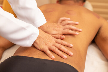 Fototapeta na wymiar Terapeuta fazendo massagem nas costas de paciente com marcas de terapia com ventosa.