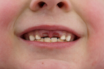Children's smile without upper milk teeth. A hole in a child's smile.