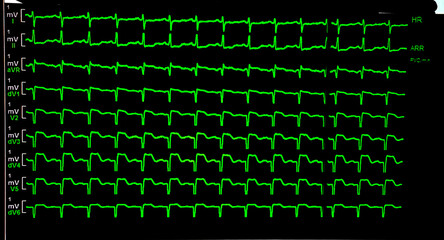 Multiple Green EKG Tracings on ICU Monitor