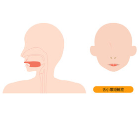 舌小帯短縮症で伸ばせない舌のイラスト　