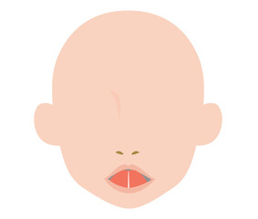 舌小帯短縮症で舌を伸ばすとハート型になるイラスト