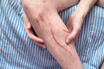 Scratched wound on a man's leg. Fresh wounds from cat claws. Damaged human lower leg.
