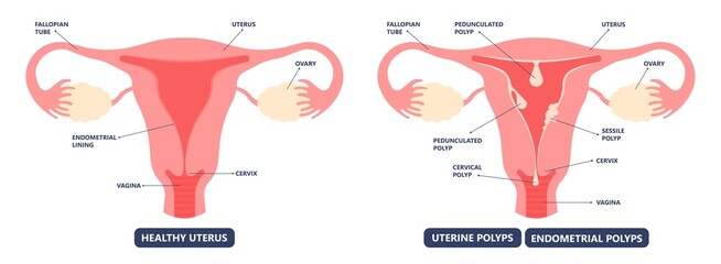 womb cancer level hormone Heavy Bleeding fertility problem infertility block tube cervix pain infection inflammation biopsy lining tumor cyst Surgical removal sessile pedicle menstruation and blood