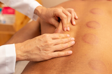 Close em mãos de terapeuta fazendo massagem em costas de paciente que está com marcas de ventosas.