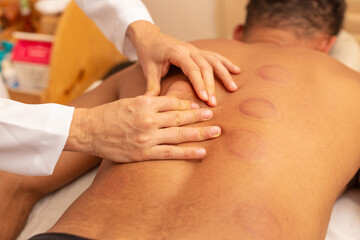 Fototapeta na wymiar Close em mãos de terapeuta fazendo massagem em costas de paciente que está com marcas de ventosas.