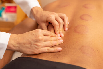 Close em mãos de terapeuta fazendo massagem em costas de paciente que está com marcas de ventosas.