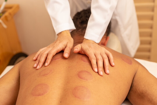 Close em m&atilde;os de terapeuta fazendo massagem em costas de paciente que est&aacute; com marcas de ventosa.