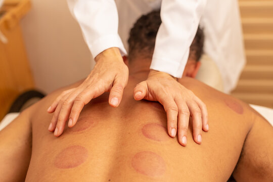 Close em m&atilde;os de terapeuta fazendo massagem em costas de paciente que est&aacute; com marcas de ventosa.