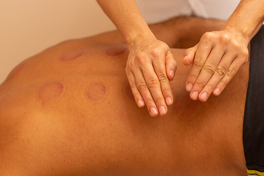 Close em mãos de terapeuta fazendo massagem em costas de paciente que está com marcas de ventosa.