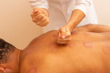 Close em mãos de terapeuta fazendo massagem em costas de paciente que está com marcas de ventosa.