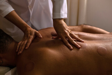 Mãos de terapeuta fazendo massagem em costas de paciente com marcas de ventosas.