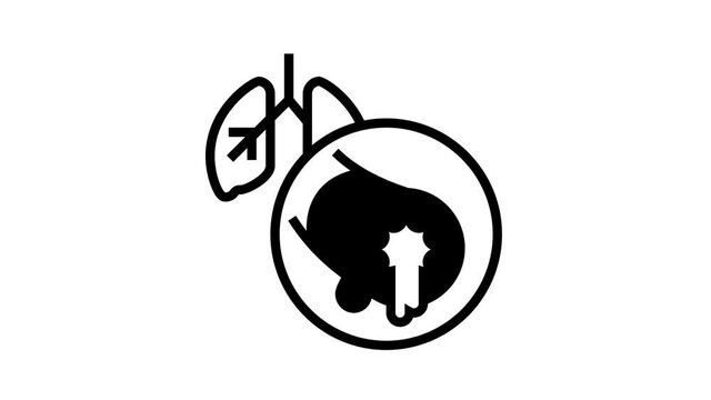 bronchiectasis respiratory disease animated black icon. bronchiectasis respiratory disease sign. isolated on white background