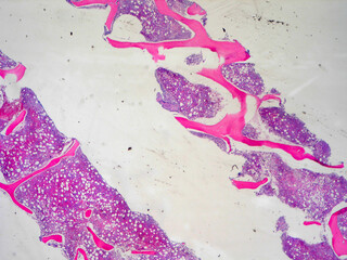 Bone marrow core biopsy pathology sections - H and E stain