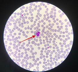 Red arrow showing neutrophil with toxic granule.