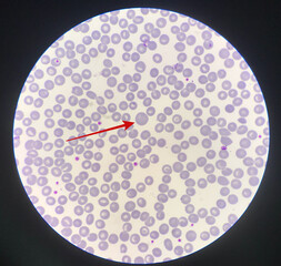 Red arrow showing red blood cell macrocyte.