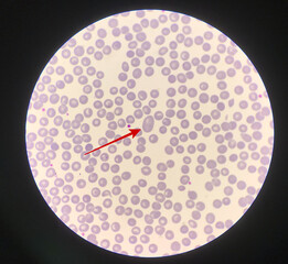 Red arrow showing red blood cell macroovalocyte.
