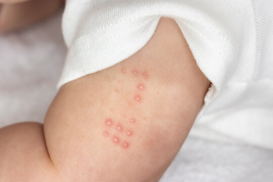 BCG注射をした赤ちゃんの腕（0歳、生後6カ月、女の子、日本人）