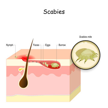 Scabies Mite