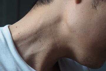 Fototapeta premium Many skin tags or Acrochordon on the neck of an Asian male. They are small soft and common benign on the human skin especially on adult skin and can be irritated by shaving and daily clothing