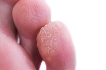 A case of verruca or plantar warts on the bottom of the small toe.  A close photo of a wart. Warts require treatment.  - obrazy, fototapety, plakaty