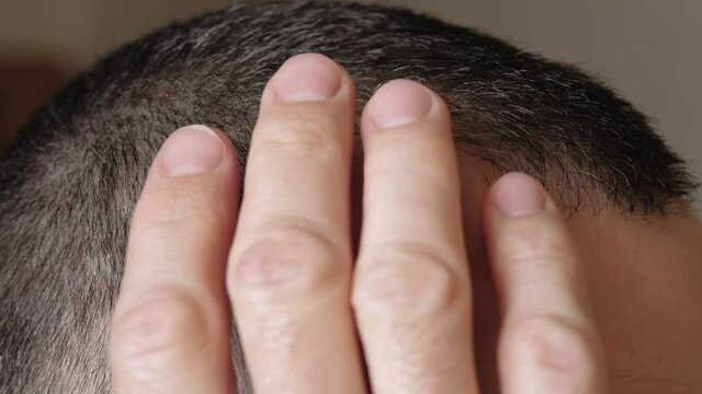 A mature man touches the scalp. Close-up of alopecia on the head. Care and hair care products. The impact of stress and the environment on human health. Barber shop concept.