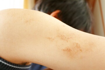 掻きむしり、色素沈着した二の腕