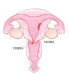 子宮膣管炎と子宮内膜炎　名称あり