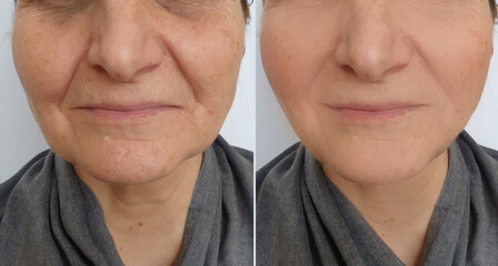 woman face wrinkles before and after treatment