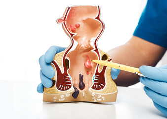 Close-up, rectum pathologies on an anatomical model. Treatment of rectal diseases, hemorrhoid - obrazy, fototapety, plakaty