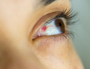 Rupture of blood vessels in a girl's eye due to high blood pressure.