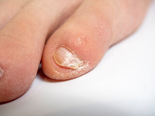 close-up of toes with nail problems. Infection, cracks, improper care. Nail care concept