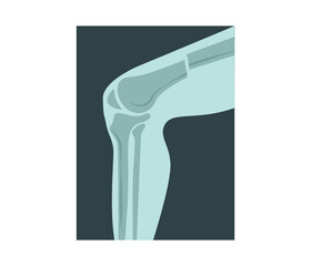 Knee joint human knee replacement x-ray view.