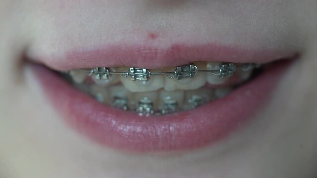 Cute young girl with dental braces. Girl teenager smiling close up