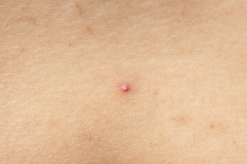 photo of nodular cystic acne skin. Chronic acne skin on woman surface.  woman with acne problem, Close up of acne on the face skin caused by the hormone and the scars