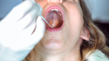A nurse wearing latex gloves inserts a swab down a woman's throat to collect a possible positive COVID-19 sample during the pandemic. Antigen test procedure.