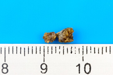 Oxalate stone, extracted from the kidney. Next to the stones is a ruler for measuring size.