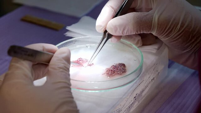 Cell culture of single hair follicles for transplantation being prepared in a petri dish using forceps, medical instruments