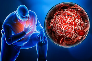 Obese or overweight man suffering a heart attack or a pulmonary embolism with a close-up image of a blood clot 3D rendering illustration. Medicine, pathology, physical pain, health concepts.