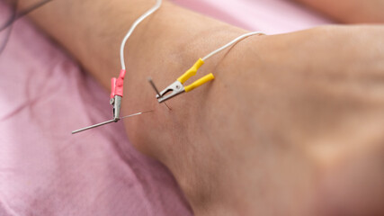 Macro shot of needles with electricity inside the ankle. patient with sprained ankle