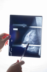X-ray mammogram image with mediolateral oblique (MLO) view of the left female breast with cysts...