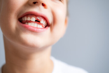 Boy without milk upper tooth in white t-shirt smiling on the gray background.