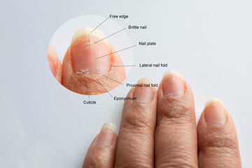 Zoom in image of Finger nail anatomy guides from real finger with brittle nail, fold cuticle and lateral nail fold problems isolated on white background
