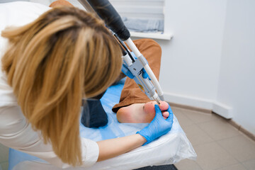 Laser removal of warts on the foot. Medical dermatological surgery in the clinic.